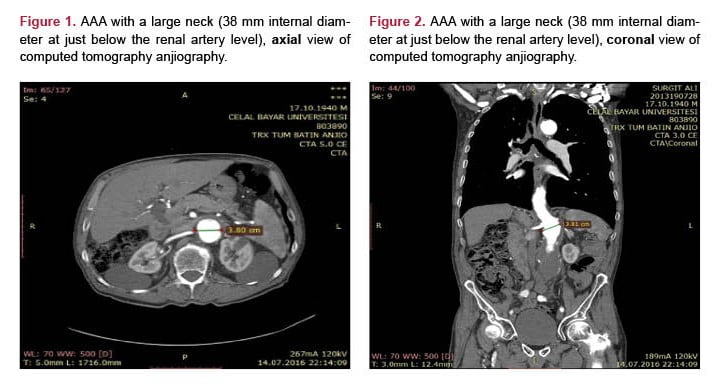 Combined System Usage For Large Neck Anatomy In A High Risk